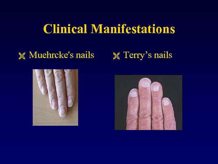 Clinical Manifestations Ë Muehrcke's nails Ë Terry’s nails 