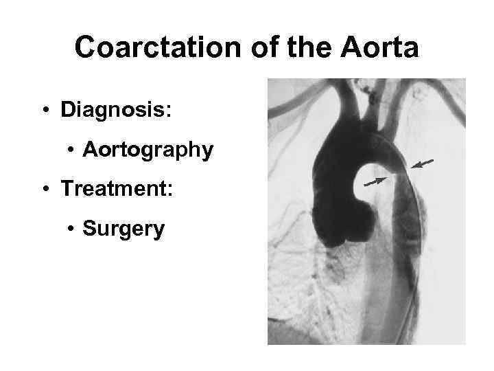 Coarctation of the Aorta • Diagnosis: • Aortography • Treatment: • Surgery 