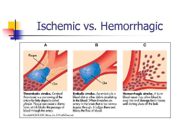 Ischemic vs. Hemorrhagic 