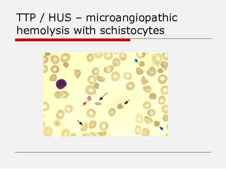 TTP / HUS – microangiopathic hemolysis with schistocytes 