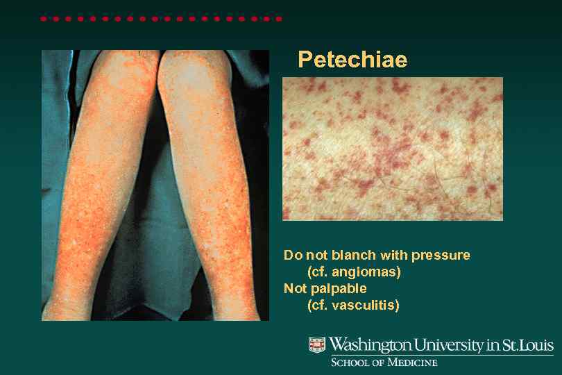 Petechiae Do not blanch with pressure (cf. angiomas) Not palpable (cf. vasculitis) 