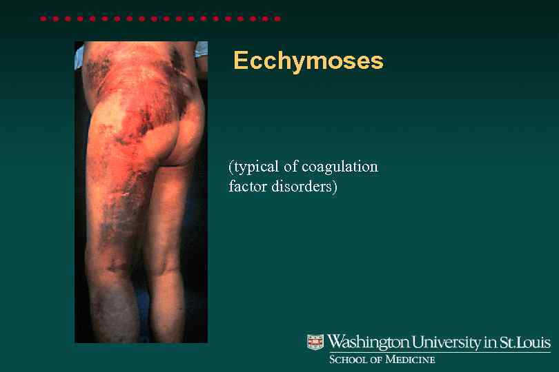 Ecchymoses (typical of coagulation factor disorders) 