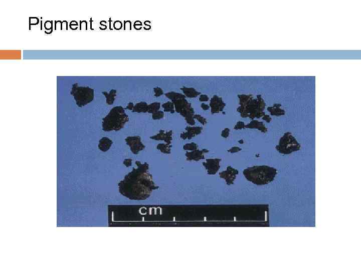 Pigment stones 