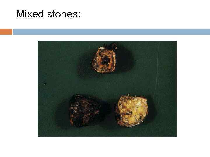 Mixed stones: 