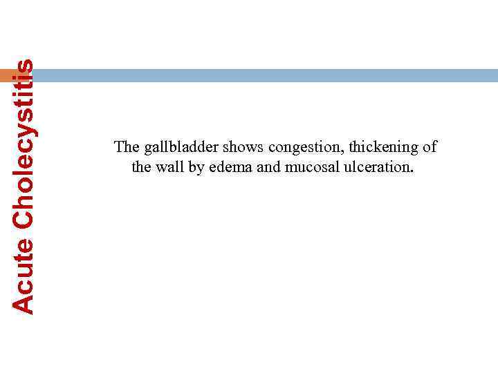 Acute Cholecystitis The gallbladder shows congestion, thickening of the wall by edema and mucosal