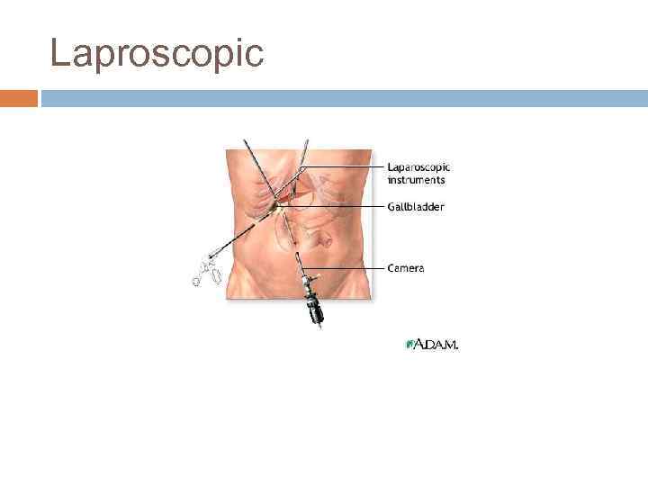 Laproscopic 