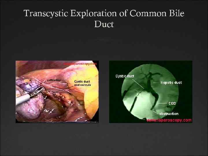 Transcystic Exploration of Common Bile Duct 