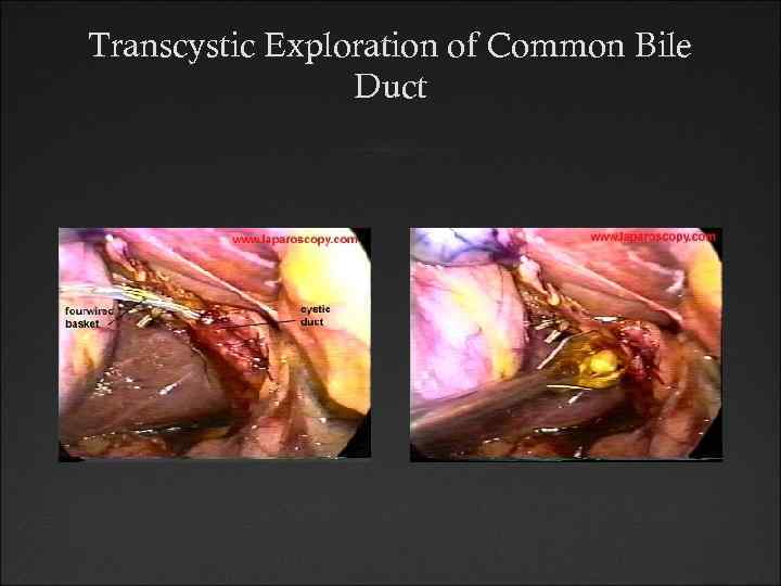 Transcystic Exploration of Common Bile Duct 