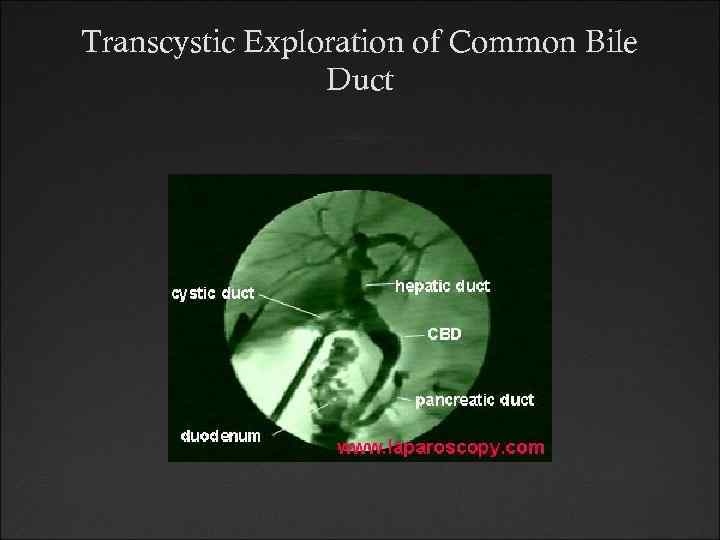 Transcystic Exploration of Common Bile Duct 