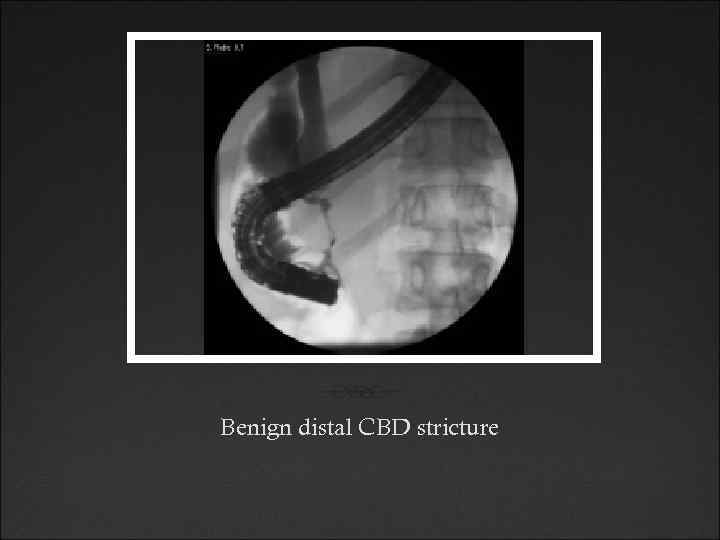 Benign distal CBD stricture 