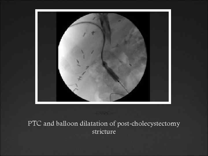 PTC and balloon dilatation of post-cholecystectomy stricture 