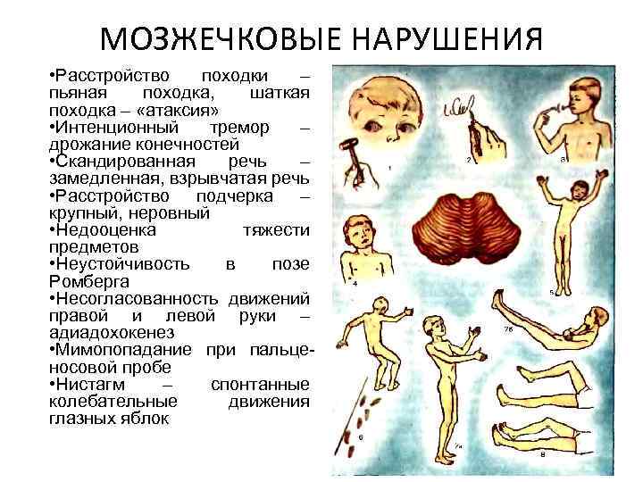 Травма мозжечка может привести к нарушению