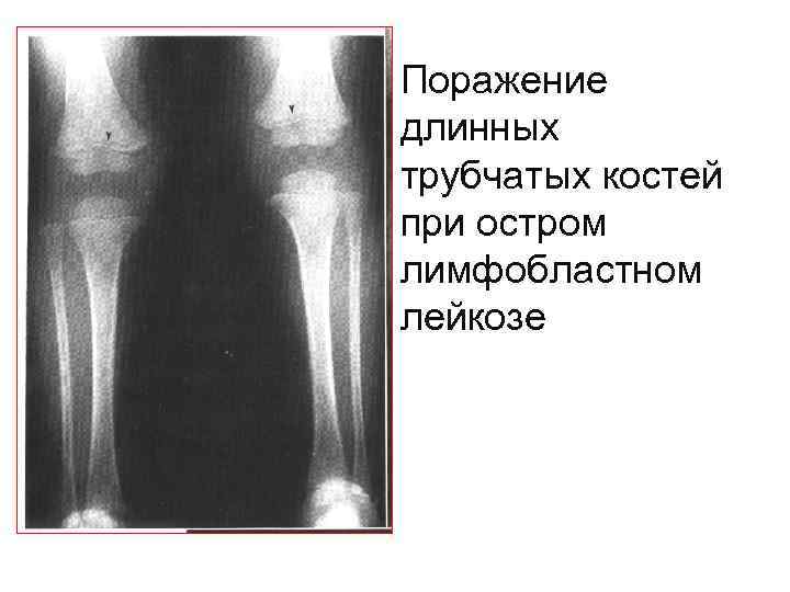 Поражение длинных трубчатых костей при остром лимфобластном лейкозе 