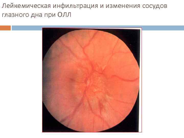 Лейкемическая инфильтрация и изменения сосудов глазного дна при ОЛЛ 