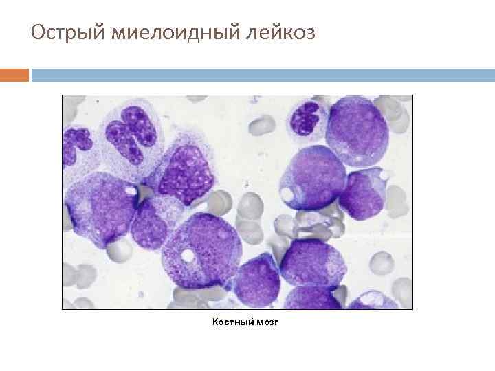 Острый миелоидный лейкоз Костный мозг 