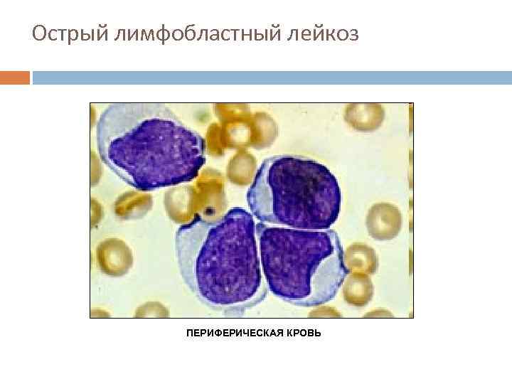 Острый лимфобластный лейкоз ПЕРИФЕРИЧЕСКАЯ КРОВЬ 