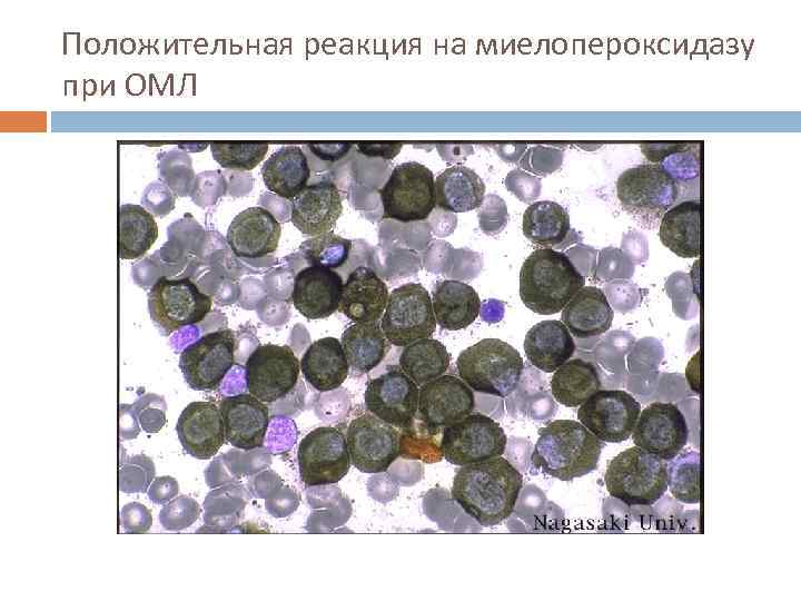 Положительная реакция на миелопероксидазу при ОМЛ 