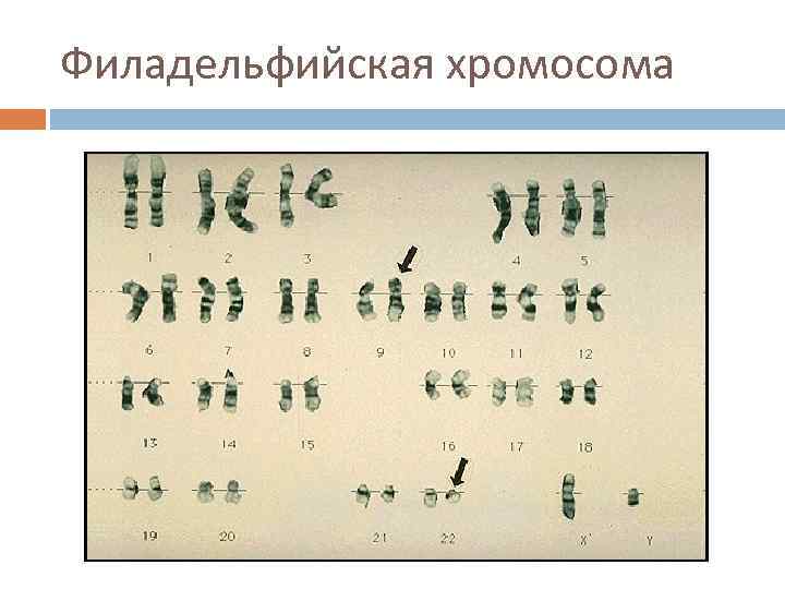 Филадельфийская хромосома 