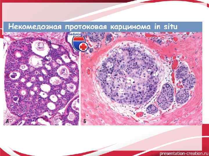 Протоковая карцинома молочной железы фото