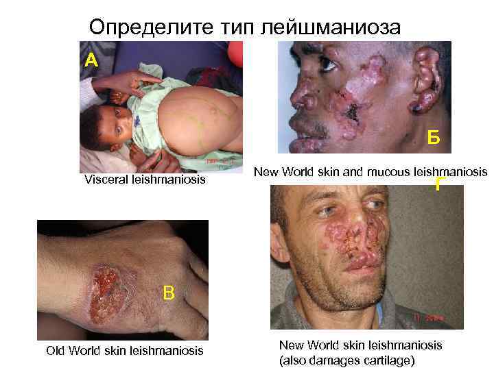 Определите тип лейшманиоза А Б Visceral leishmaniosis New World skin and mucous leishmaniosis Г