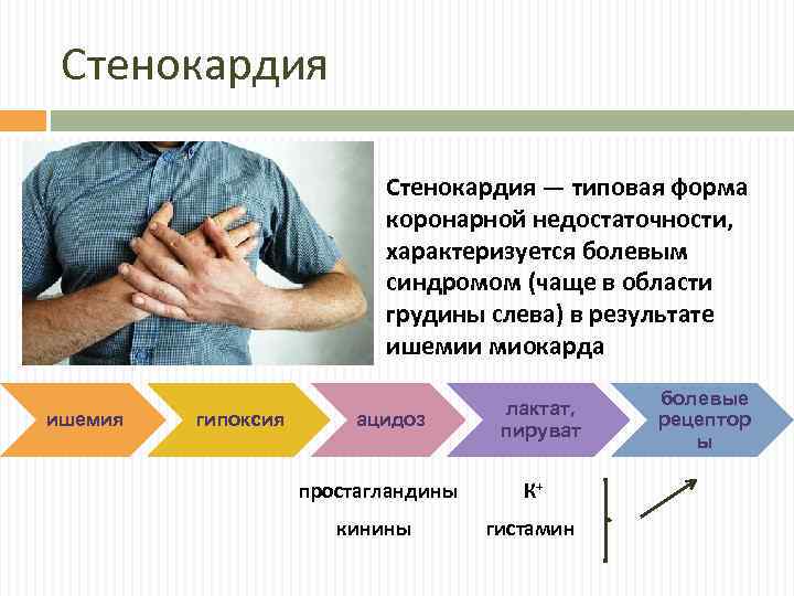 Стенокардия — типовая форма коронарной недостаточности, характеризуется болевым синдромом (чаще в области грудины слева)