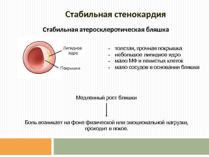 Стабильная стенокардия Стабильная атеросклеротическая бляшка Липидное ядро Покрышка - толстая, прочная покрышка небольшое липидное