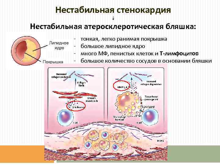 Нестабильная стенокардия Нестабильная атеросклеротическая бляшка: Липидное ядро Покрышка - тонкая, легко ранимая покрышка большое