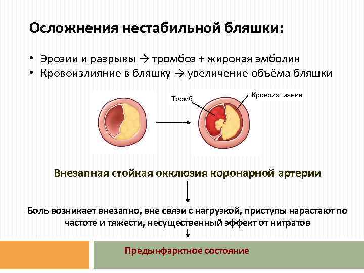 Осложнения нестабильной бляшки: • Эрозии и разрывы → тромбоз + жировая эмболия • Кровоизлияние