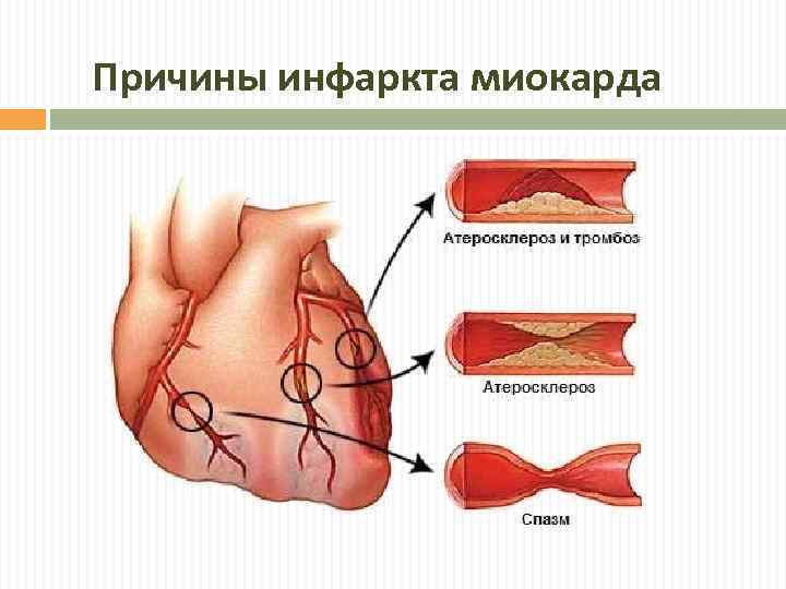 Причины инфаркта миокарда 