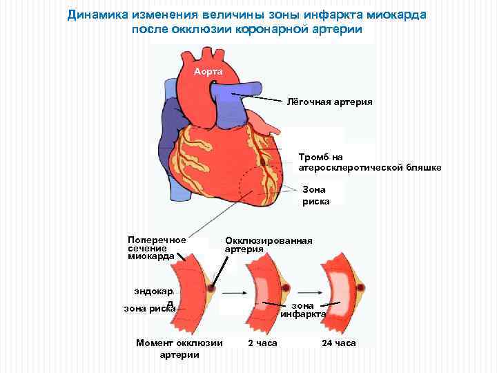 Динамика изменения величины зоны инфаркта миокарда после окклюзии коронарной артерии Аорта Лёгочная артерия Тромб