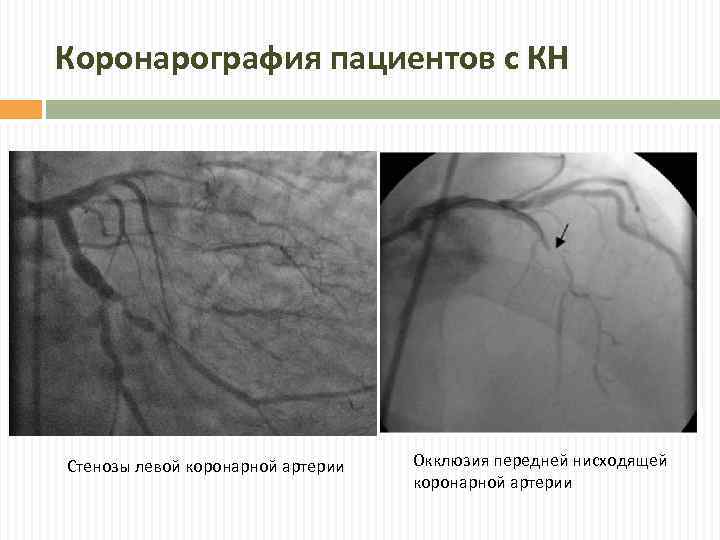 Коронарография пациентов с КН Стенозы левой коронарной артерии Окклюзия передней нисходящей коронарной артерии 