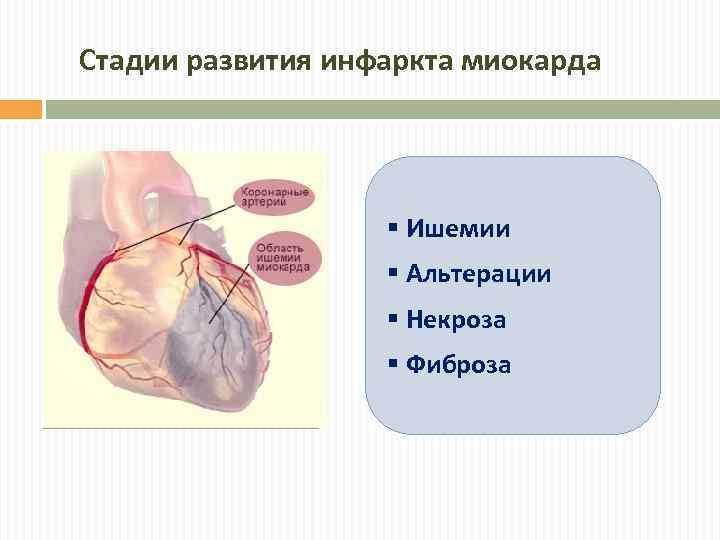 Стадии развития инфаркта миокарда § Ишемии § Альтерации § Некроза § Фиброза 