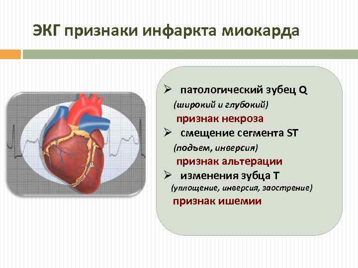 ЭКГ признаки инфаркта миокарда Ø патологический зубец Q (широкий и глубокий) признак некроза Ø