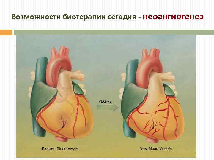 Возможности биотерапии сегодня - неоангиогенез 