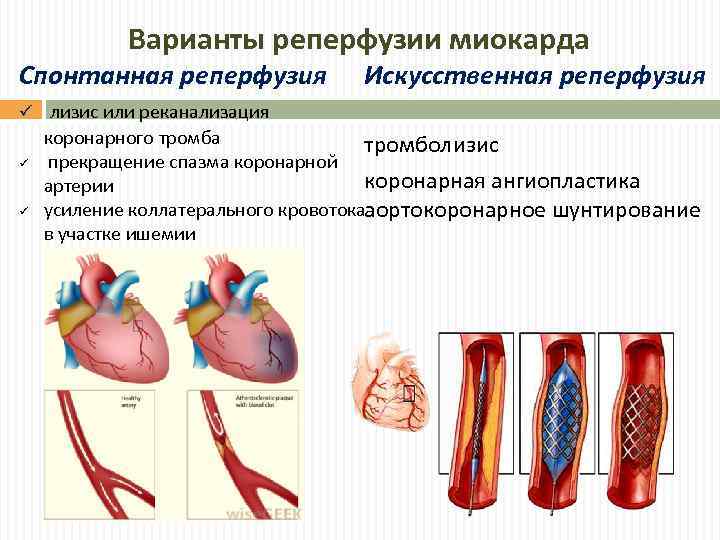 Варианты реперфузии миокарда Спонтанная реперфузия ü ü ü Искусственная реперфузия лизис или реканализация коронарного