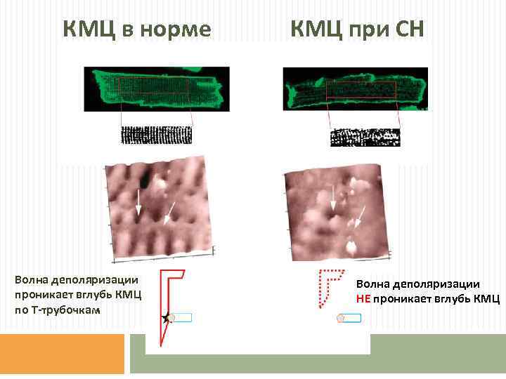 КМЦ в норме Волна деполяризации проникает вглубь КМЦ по Т-трубочкам КМЦ при СН Волна