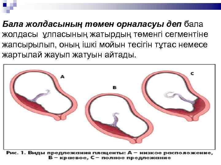 Бала жолдасының төмен орналасуы деп бала жолдасы ұлпасының жатырдың төменгі сегментіне жапсырылып, оның ішкі