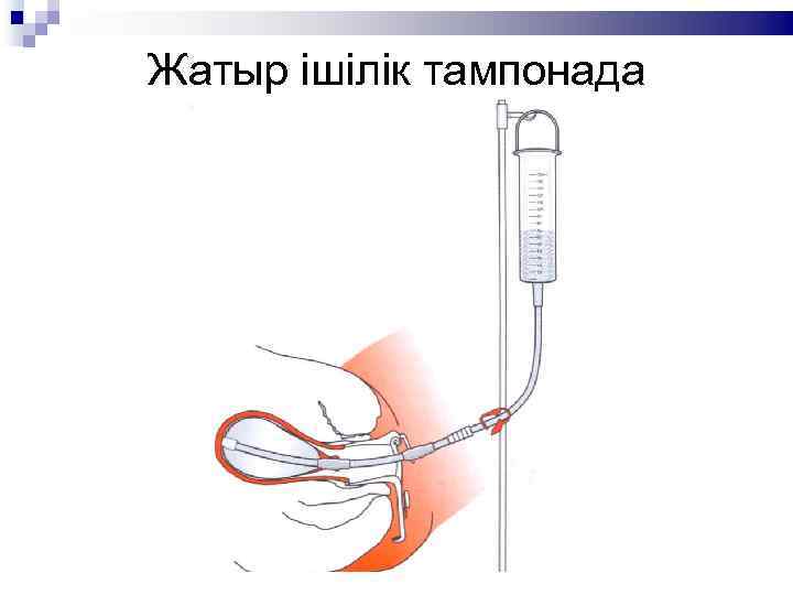 Жатыр ішілік тампонада 