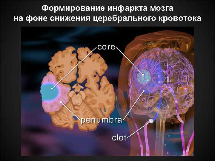 Формирование инфаркта мозга на фоне снижения церебрального кровотока 
