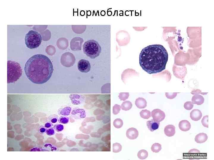 Нормоциты фото под микроскопом