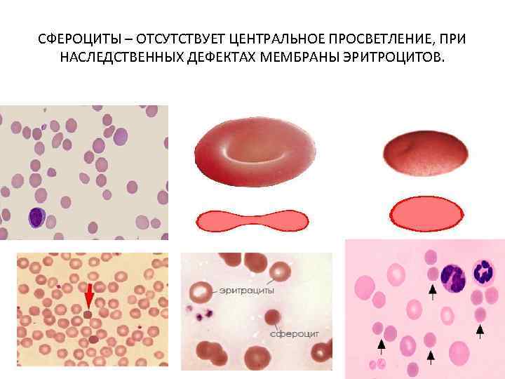 Болезнь минковского шоффара презентация