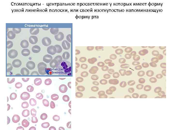 Стоматоциты - центральное просветление у которых имеет форму узкой линейной полоски, или своей изогнутостью