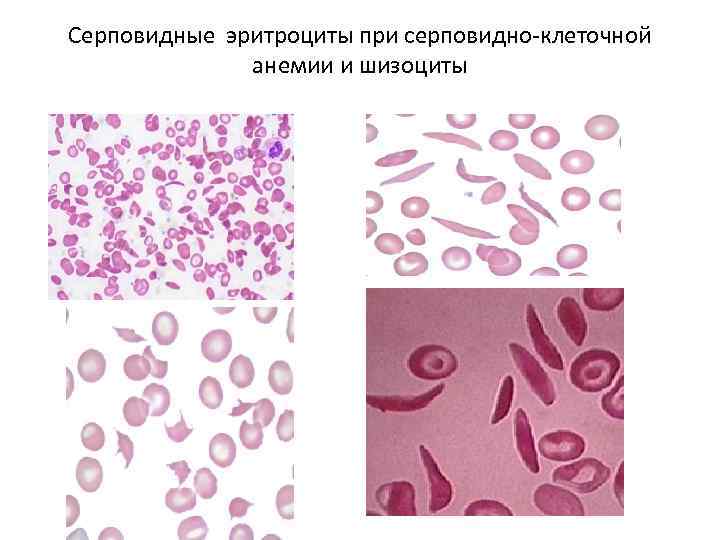 Эритроциты при серповидно клеточной анемии