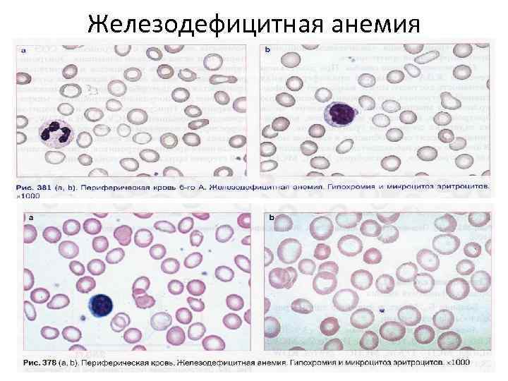 Железодефицитная анемия 