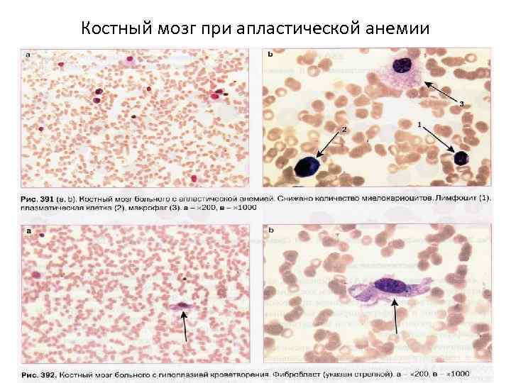 Картина костного мозга при множественной миеломе характеризуется