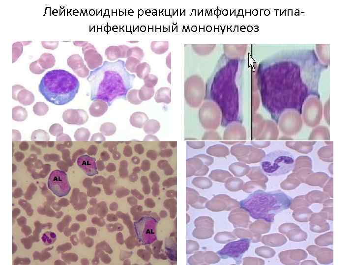 Злокачественные новообразования лимфоидной кроветворной ткани. Картина крови при лейкемоидной реакции. Бластные клетки при лейкемоидной реакции. Промиелоцитарные лейкемоидные реакции. Лейкемоидная реакция костный мозг.