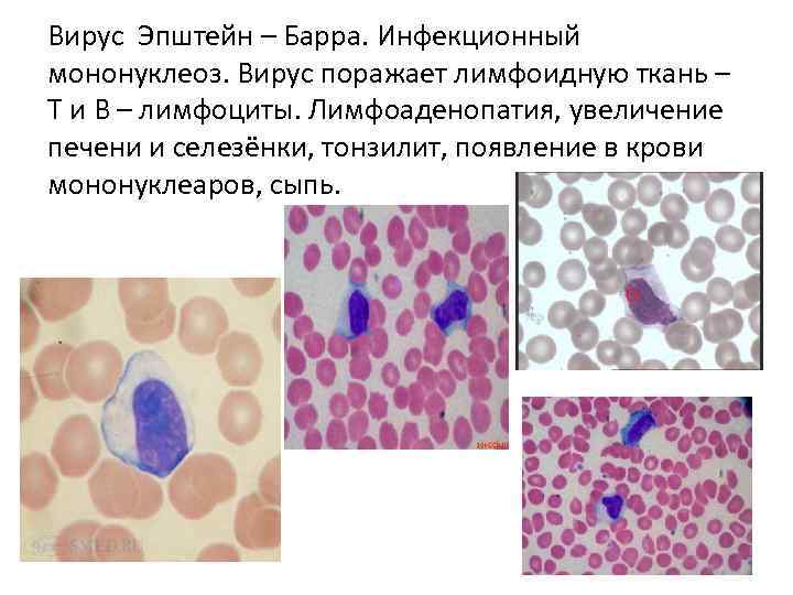 Мононуклеоз вирус эпштейна. Атипичные мононуклеары микроскопия. Атипичные мононуклеары в крови. Инфекционный мононуклеоз в мазке крови. Мононуклеарные клетки периферической крови.