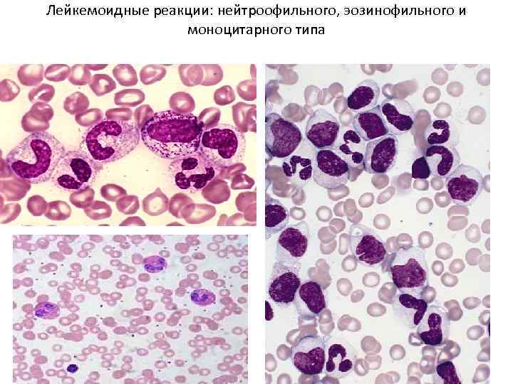 Лейкозы лейкемоидные реакции. Картина крови при лейкемоидной реакции. Лейкемоидные реакции лимфоидного типа. Лейкемоидные реакции моноцитарного типа.