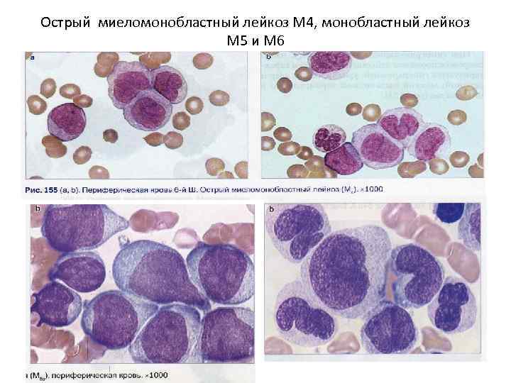 Миеломоноцитарный лейкоз картина крови