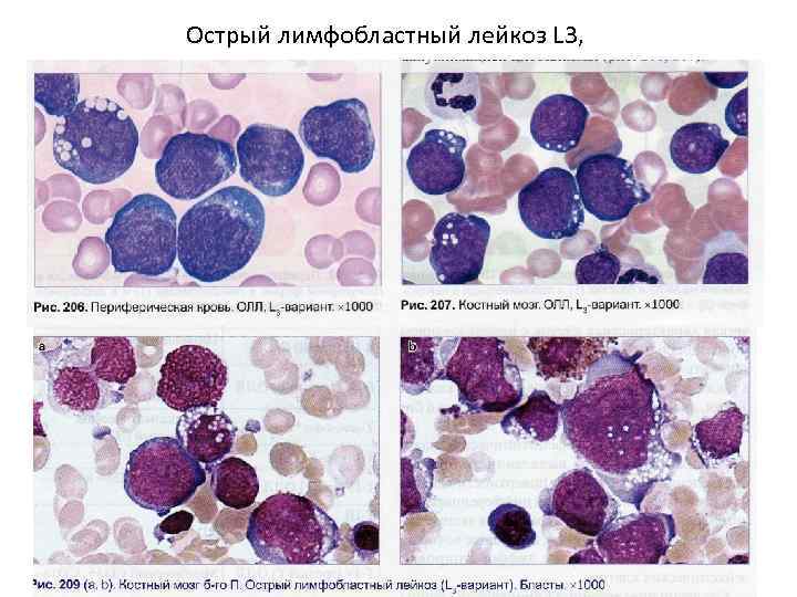 Острый лимфобластный лейкоз презентация